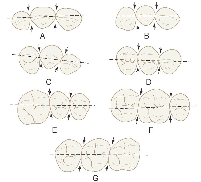 Outline drawings of the maxillary teeth from the incisal and occlusal aspects with broken lines bisecting the contact areas. These illustrations show the relative positions of the contact areas labiolingually and buccolingually. Arrows point to embrasure spaces. A, Central incisors and lateral incisor. B, Central and lateral incisors and canine. C, Lateral incisor, canine, and first premolar. D, Canine, first premolar, and second premolar. E, First molar, second premolar, and first molar. F, Second premolar, first molar, and second molar. G, First, second, and third molars.