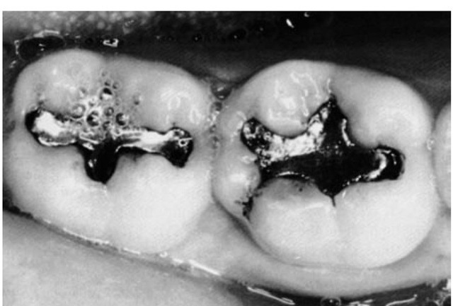 Broad contact areas of the mandibular first and second molars in a young adult, 21 years old.