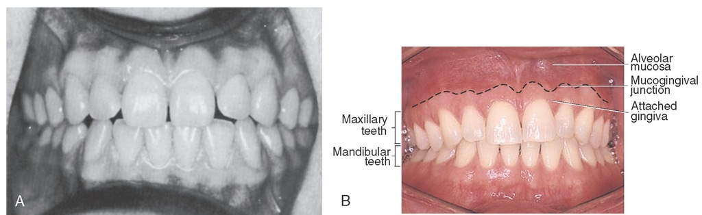  The form of the gingiva is related to the form of the teeth, contact areas, spacing between the teeth, and effects of periodontal disease and dental caries. A, Interdental papillae do not fill the interproximal areas in several places because of spacing between the teeth. B, Clinically normal gingivae; the form is different because of the form of the teeth, including contact areas.