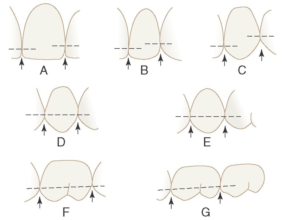 Outline drawings of the maxillary teeth in contact, with dotted lines bisecting the contact areas at the various levels as found normally. Arrows point to embrasure spaces. A, Central and lateral incisors. B, Central and lateral incisors and canine. C, Lateral incisor, canine, and first premolar. D, Canine and first and second premolars. E, First and second premolars and first molar. F, Second premolar, first molar, and second molar. G, First, second, and third molars.