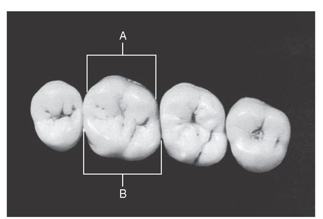 Calibration of maxillary first molar. A, Calibration at prominent buccal line angles that functions by deflecting food material during mastication. B, Calibration of lingual contour from contact area mesially to contact area distally. There are no prominent line angles, but the development of the mesiolingual cusp has widened the rounded lingual form. Thus the two lingual embrasures are kept similar in size, even though the tooth makes contact with two teeth that are dissimilar lingually. This way, the lingual gingival tissue interproximally is properly protected by the equalization of lingual embrasures.