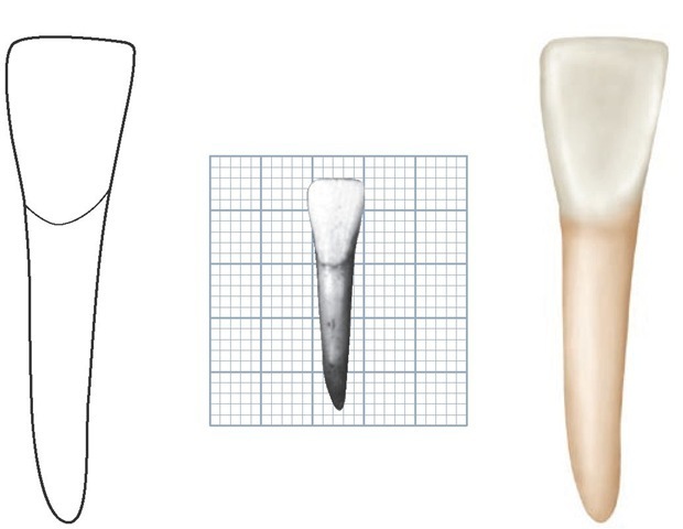 Mandibular right lateral incisor, labial aspect. (Grid = 1 sq mm.)