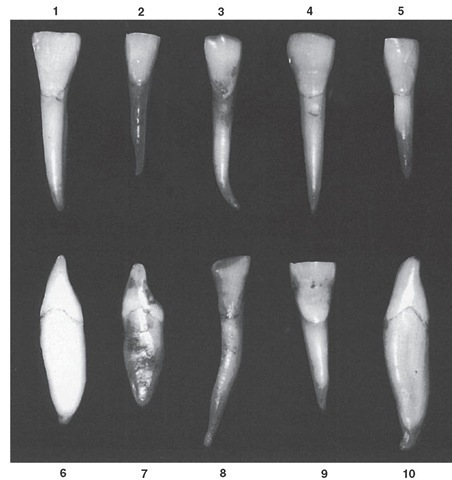 Mandibular lateral incisor. Ten specimens with uncommon variations are shown. 1, Tooth very large; cervix constricted in comparison with crown width. 2, Specimen well formed, smaller than average. 3, Root extra long; extreme curvature at apical third; mesial and middle mamelons intact on incisal ridge. 4, Extreme mesiodistal measurement for crown length; contact areas very broad cervicoincisally. 5, Specimen undersized. 6, Incisal ridge thin; little or no curvature at cervical third of crown. 7, Incisal edge labial to center of root; root rounded; cingulum with more curvature above root than average. 8, Malformed crown and root; root with extreme length. 9, Crown very wide; root short. 10, Very slight curvature at cervical third of crown; entire tooth oversized, malformation at root end.