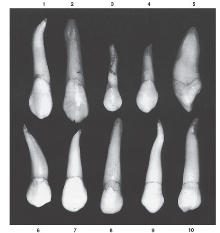 Maxillary canine. Ten specimens with uncommon variations are shown. 1, Crown very long, with extreme curvature at apical third of the root. 2, Entire tooth unusually long. Note hypercementosis at root end. 3, Very short crown; root small and malformed. 4, Mesiodistal dimension of crown at contact are extreme; calibration at cervix narrow in comparison; root short for crown of this size. 5, Extreme labiolingual calibration; root with unusual curvature. 6, Tooth malformed generally. 7, Large crown; short root. 8, Root overdeveloped and very blunt at apex. 9, Odd curvature of root; extra length. 10, Crown poorly formed; root extra long.