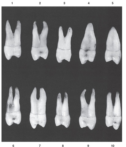 Maxillary first premolar, mesial aspect. Ten typical specimens are shown.