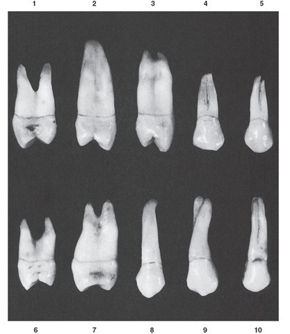  Maxillary first premolar. Ten specimens with uncommon variations are shown. 1, Constricted occlusal surface; short roots. 2, Single root of extreme length. 3, Constricted occlusal surface; mesial developmental groove indistinct on mesial surface of root. 4, Short root form, with two buccal roots fused. 5, Short root form, with two buccal roots showing bifurcation. 6, Short roots, with considerable separation. 7, Buccolingual calibration greater than usual. 8, Root extremely long; distal contact area high. 9, Twisted buccal root. 10, Three roots fused; roots are also uncommonly long.