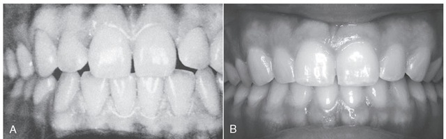 Clinical observations: clinical crowns. Note the difference in the shapes of the teeth in A and B, as well as the interdental spacing, and the presence and location of interproximal tooth contacts. Consider the contours of the roots (A), the occlusal contacts of the incisor, canine, and premolar teeth), and the gingiva of the maxillary right central incisor, and the esthetics presented in both A and B. 