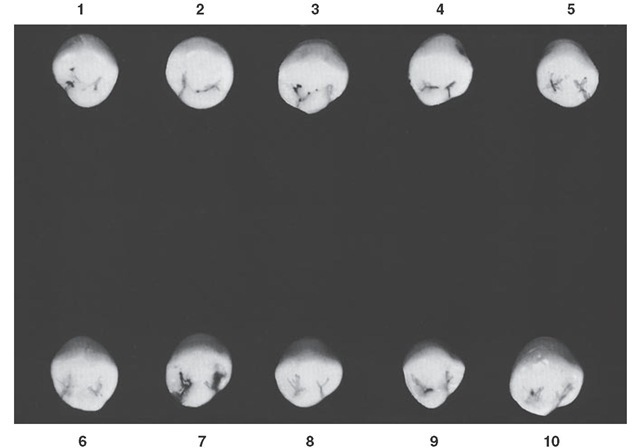 Mandibular first premolar, occlusal aspect. Ten typical specimens are shown.