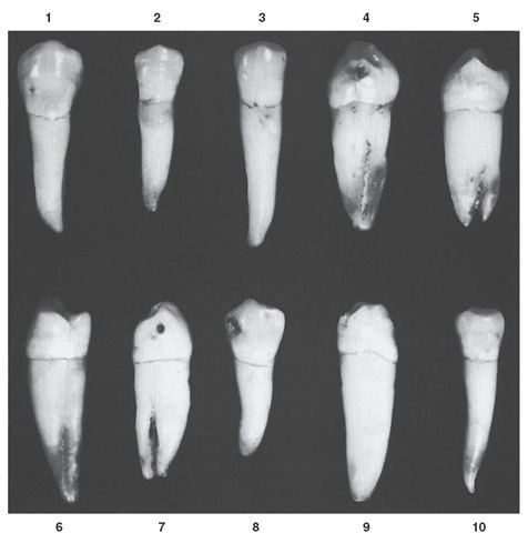 Mandibular first premolar. Ten specimens with uncommon variations are shown. 1, Crown oversized. 2, Crown and root diminutive. 3, Mesial and distal sides of crown straight; cervix wide mesiodistally; root extra long. 4, Unusual formation of lingual portion of crown; root with deep developmental groove mesially. 5, Bifurcated root. 6, Lingual cusp long; little lingual curvature; root of extra length. 7, No lingual cusp; root bifurcated. 8, Dwarfed root. 9, Crown poorly formed; root unusually long. 10, Very long curved root for crown so small.