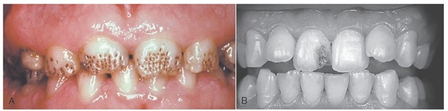 A, Hypoplasia of the enamel. B, Defect in tooth structure caused by trauma to the primary predecessor during development of the permanent central incisor. 