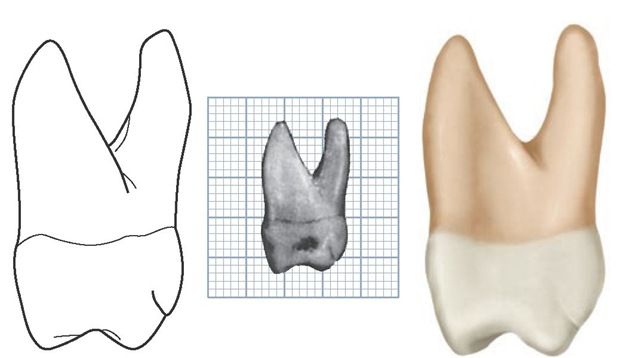Maxillary right first molar, mesial aspect. (Grid = 1 sq mm.)