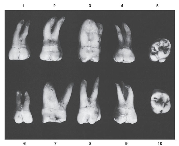 Maxillary first molar. Ten specimens with uncommon variations are shown. 1, Unusual curvature of buccal roots. 2, Roots abnormally long with extreme curvature. 3, Lingual and distobuccal roots fused. 4, Mesiodistal measurement of root trunk smaller than usual. 5, Extreme rhomboidal development of crown; fifth cusp with maximum development. 6, Tooth well developed but much smaller than usual. 7, Extreme buccolingual measurement. 8, Extreme length, especially of the distobuccal root; buccal cusps narrow mesiodistally. 9, Well-developed crown; roots poorly developed. 10, Extreme development of lingual portion of the crown compared with buccal development.
