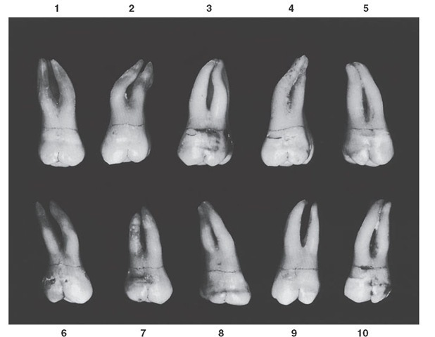 Maxillary second molar, buccal aspect. Ten typical specimens are shown.