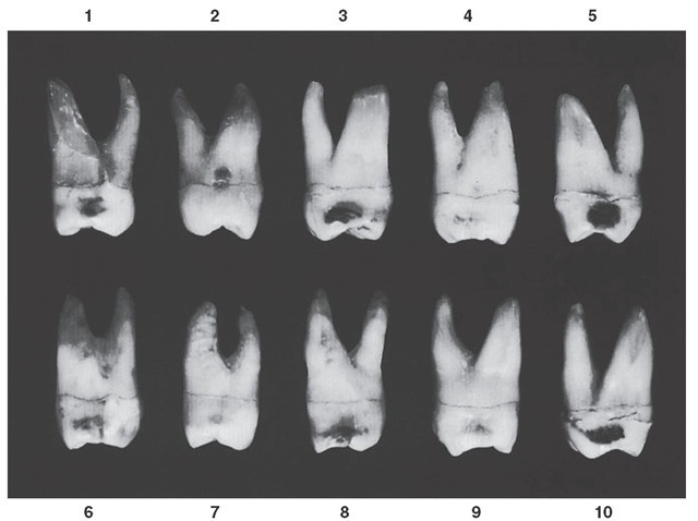 Maxillary second molar, mesial aspect. Ten typical specimens are shown.