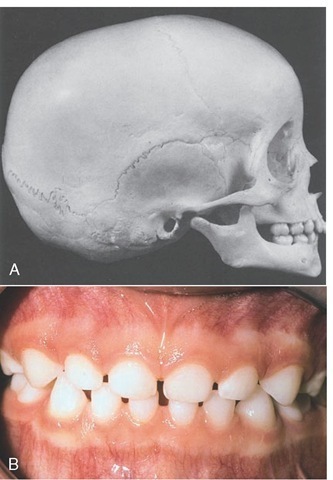  A, Skull of child 4 years old with completed primary Jentition. B, Completed primary dentition. Note the incisal wear. 