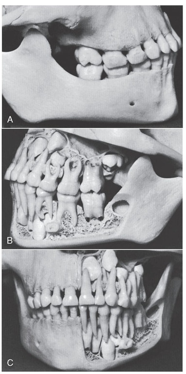  Same child as in Figure 2-10. A, Right side. B, Left side showing position of first permanent molars and empty bony crypt of developing second molar lost during preparation of the specimen. C, Front view showing right side with bone covering roots and developing permanent teeth, and left side with developing anterior permanent teeth. 