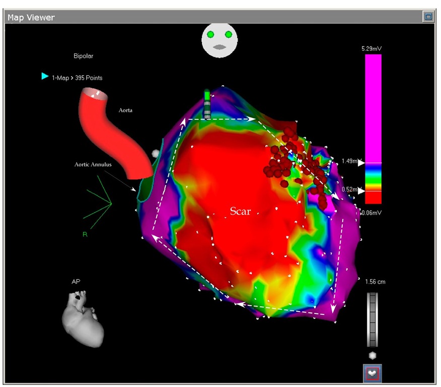The picture shows the antero-posterior projection of the enlarged left ventricle with a large scar on almost all the anterior wall. Any voltage bellow 0.5 mV (red color) was considered scar and any voltage above 1.5 mV were considered normal myocardium (purple color). In between them three transitional tissues are collared in yellow, green and blue. No tissue penetrated the scar and no central pathways could be mapped. The arrows show the large reentry cycle around the scar. Normal myocardium is around the scar and constitutes the reentry circle. The ablation points (red dots) block the isthmus between two scars.
