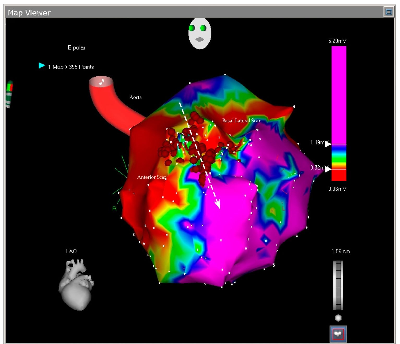 The picture shows the antero-lateral projection of the left ventricle. In this voltage mapping two scars are evident: the large anterior scar and a smaller basal lateral scar. The scars delineate in between them a slowly conducting myocardial tissue called isthmus (arrow). The isthmus is blocked by the ablation points. As we will see in the next picture, the basal scar is extending until the mitral annulus the reason why the reentry could not be closed around it. 