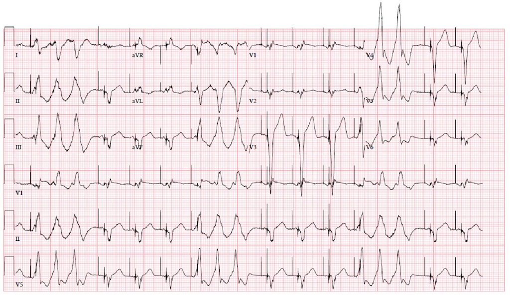 The clinical VT in non-sustained form, but with the same morphology of RBBB, inferior and rightward axis 