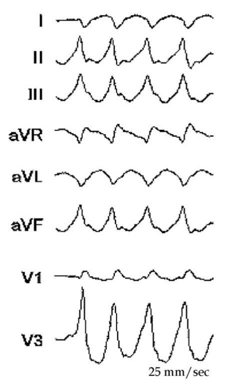 The figure shows the ECG of the VT during the ablation. This VT had RBBB configuration and inferior and rightward axis. This configuration is suggesting a left ventricular VT with the origin in the basal area.