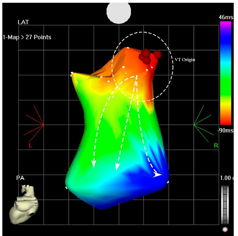 The picture shows the potero-anterior projection of a part of the left ventricle during the VT. The earliest points are located on the basal posterior wall (red area) and the VT is propagated to the apical are as shown by the arrows (blue area). Ablation in this area terminated the VT and rendered it non-inducible. 