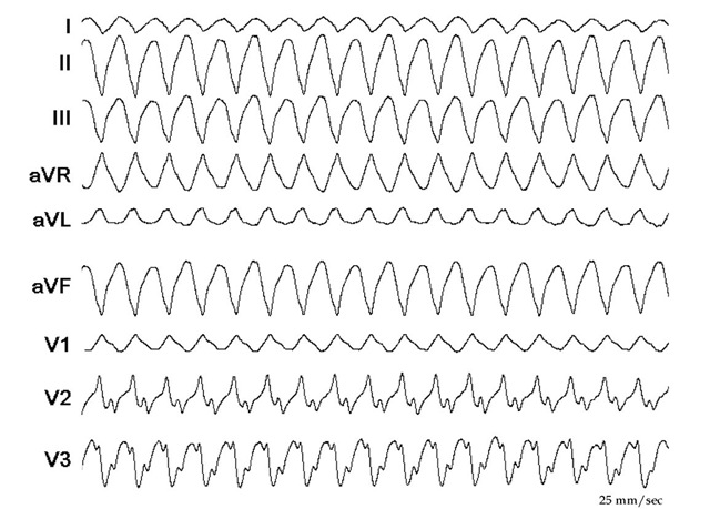 The figure shows the ECG of the second VT during the ablation two weeks after the first one. The QRS has an RBBB configuration and superior axis. When compared with the first VT (Figure 7.5), the rightward axis is less expressed (L1 compared in the two ECGs, and AVL in the first ECG is negative and in the second is positive). There are also differences in the chest leads available (V3 is strongly positive in the first VT and clearly negative in the second VT). The rates of the VTs are similar. 