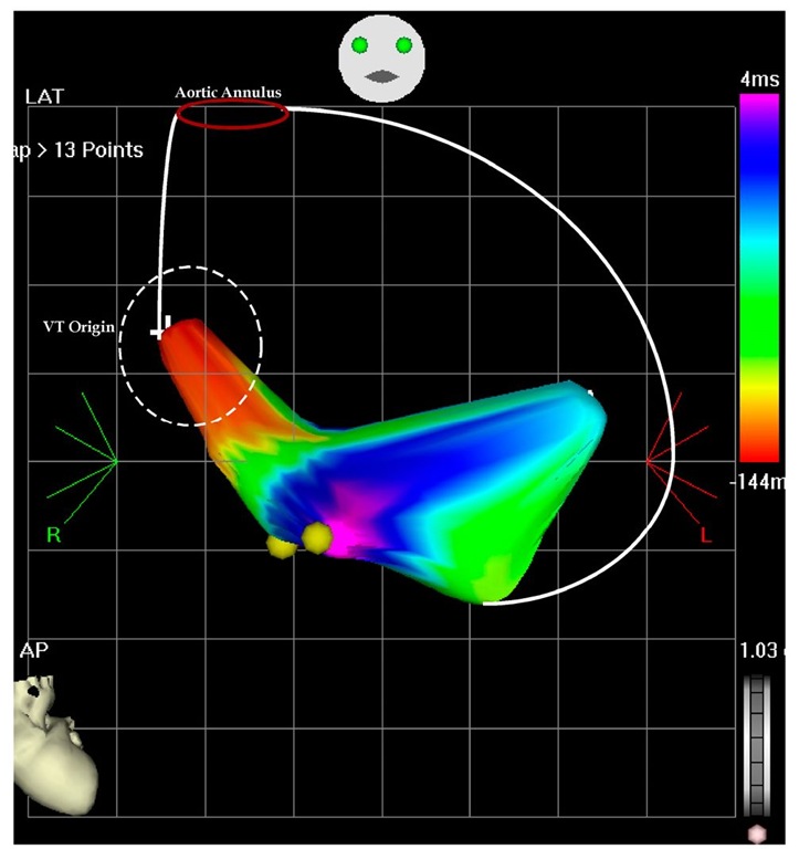 The picture shows an antero-posterior projection of the left ventricular flow map during VT at the second ablation procedure. The left ventricular perimeter is shown with the white lines, including the aortic annulus. The earliest points are originating on the septal area and propagate in the anterior and posterior wall. There is collision on the inferior wall (pink color) and is tagged. The earliest points are -144 msec before the reference catheter in the right ventricle and the collision is 4 msec after the reference catheter. 