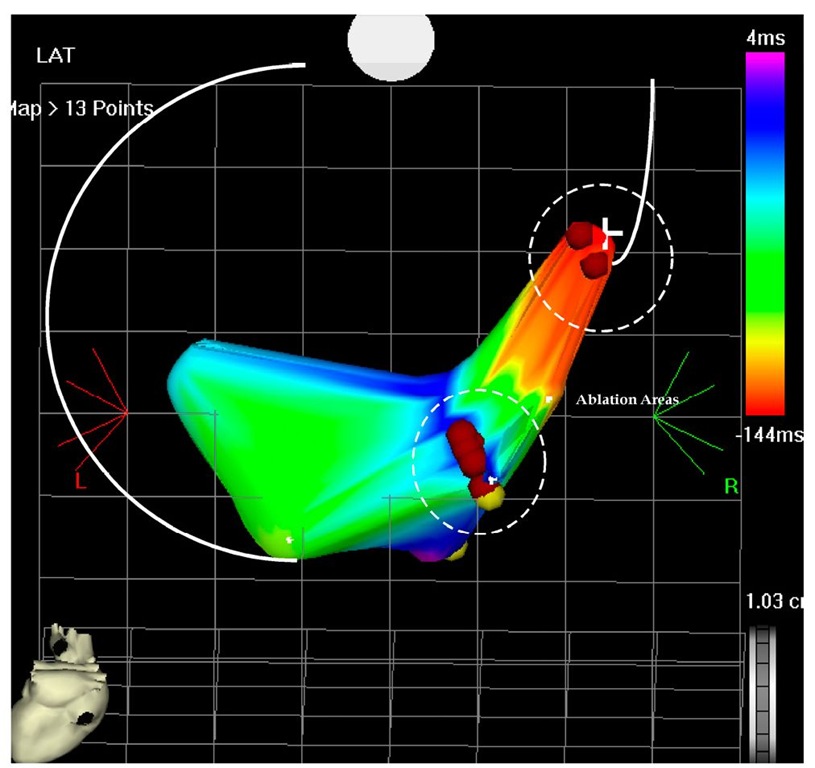 The picture shows the flow map of the left ventricle in postero-anterior projection. Two areas had to be ablated to terminate the VT, first the higher area and earliest one was ablated than the second more inferior are which has become early (not shown) and finally terminated the VT and left it non-inducible. 