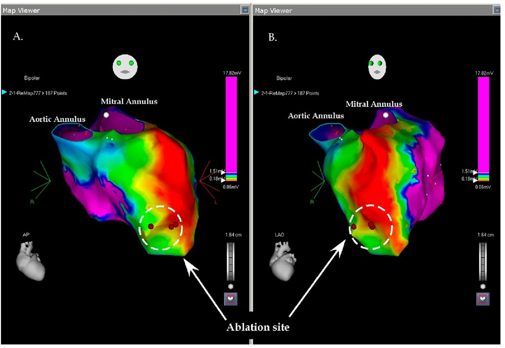 The picture shows the voltage mapping of the left ventricle in two projections: A. antero-posterior; B. left anterior oblique; the ventricle is enlarged with a large apical aneurysm and a large antero-lateral scar. The ablation site is shown in both projections and the ablation was completed during incessant ventricular tachycardia (135 BPM) and propagation mapping. With the two lateral applications the tachycardia terminated spontaneously. 