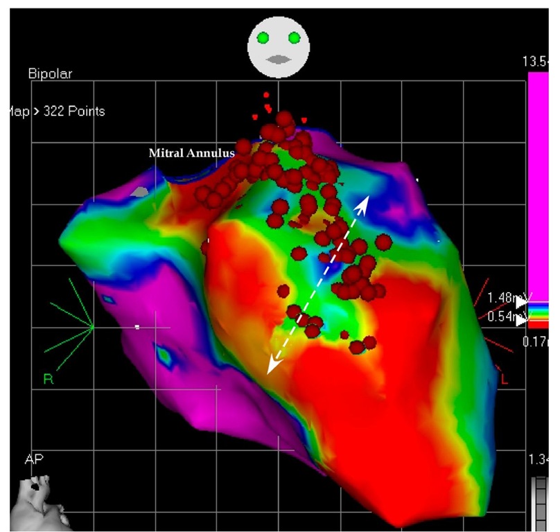 The picture shows the mapping during the second ablation attempt. This is an antero-posterior projection of the left ventricular voltage mapping. The normal tissue was defined as >1.5 mV (like in Figure 6.11), but the scar was defined as <0.5 mV. A large invagination of myocardium into the basal scar was revealed and ablated.