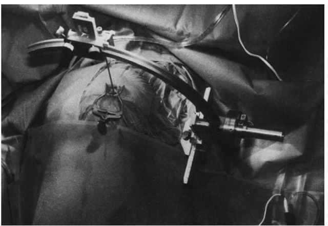 Intraoperatively, mounting the localizing unit and positioning the biopsy needle. 