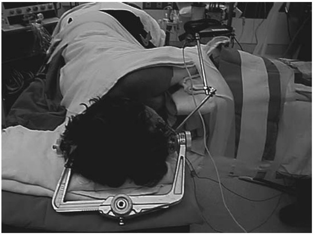 Setup for awake craniotomy. Mayfield clamp is not secured to the table allowing some head movement during surgery while tracking is maintained. 