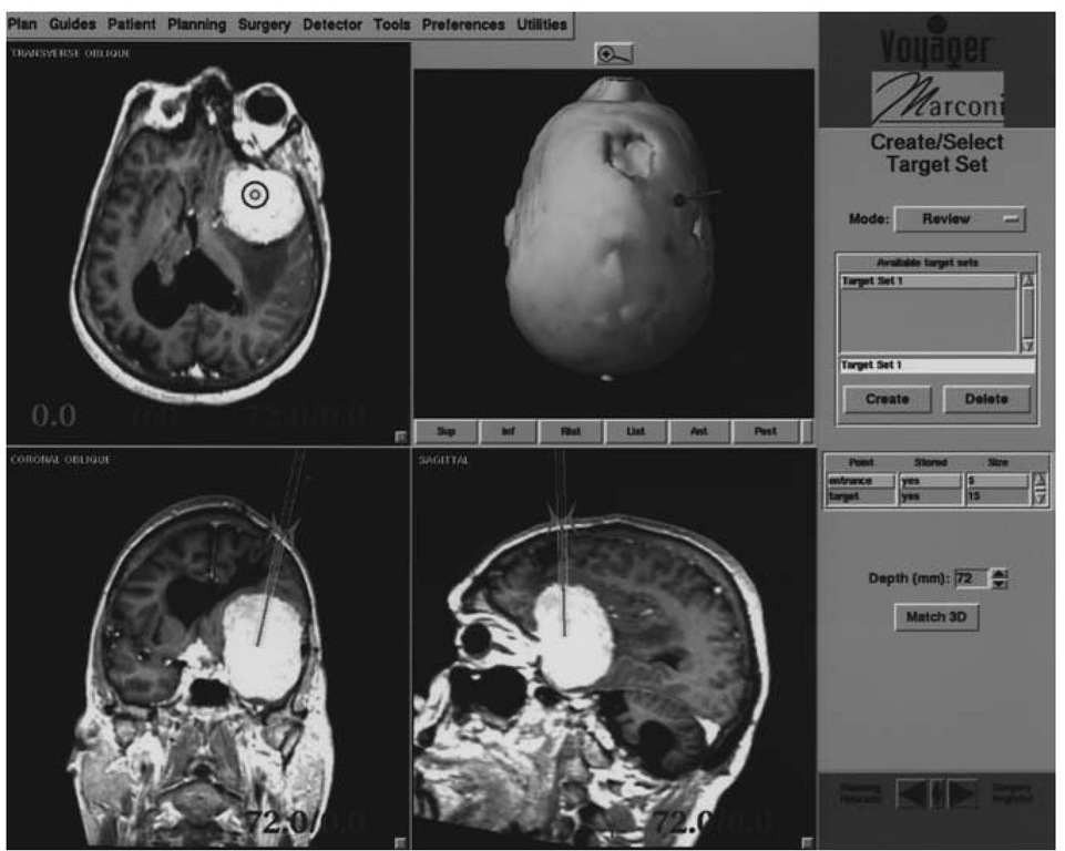 Display for target and trajectory guidance. Top left screen is plane containing target point and perpendicular to pointing device. Bottom row shows planes containing pointing device and projection of planned trajectory. Top right shows surface representation of the head with planned and actual trajectory. This system facilitates brain biopsy and related procedures. 