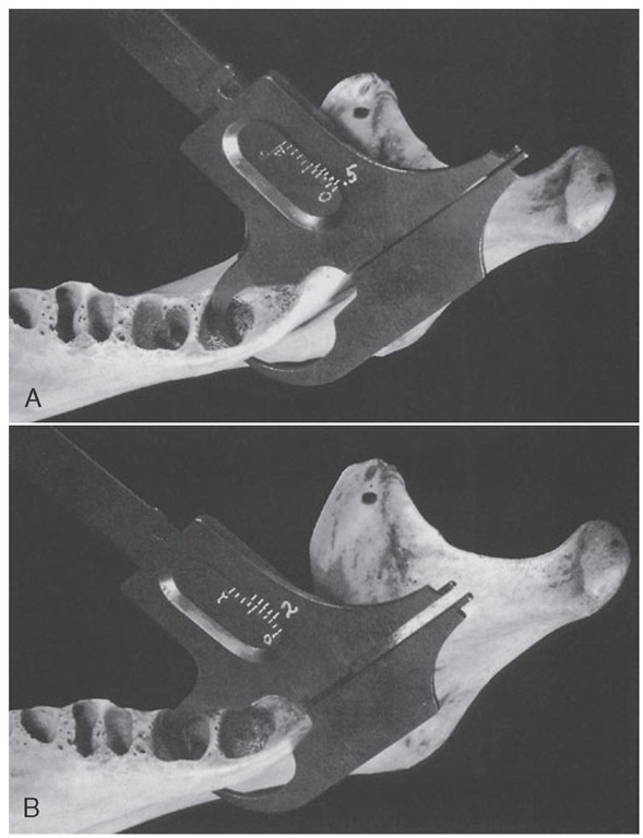 Illustration of the relative thickness of bone covering lingual mandibular second and third molar roots. A, Measurement of the thickness of bony cover lingual to the apex of the third mandibular molar immediately below the mylohyoid ridge. It measures only 0.5 mm. B, Repetition of measurement in the deepest portion lingually of the second molar alveolus. It measures fully 2 mm. 