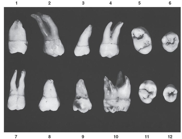  Maxillary third molar. Twelve specimens with uncommon variations are shown. 1, Very short fused root form. 2, Extremely long roots with extreme distal angulation. 3, Complete fusion of roots with extreme distal angulation. 4, Three roots well separated; crown very wide at cervix. 5, Extreme rhomboidal outline to crown, with developmental grooves oddly placed. 6, Overdeveloped mesiobuccal cusp. 7, Crown wide at cervix, with roots perpendicular. 8, Very large crown; poorly developed root form. 9, Complete absence of typical design. 10, Specimen abnormally large, with four roots well separated. 11, Five well-developed cusps, atypical in form. 12, Small specimen, atypical cusp form.