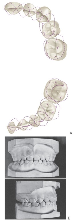  Occlusal contact relations of primary dentition. A, Contacts on maxillary teeth (top) and contacts on mandibular teeth (bottom). B, Casts of normally developed teeth of a child 6 years of age. Top, Frontal view. Bottom, Sagittal view. 