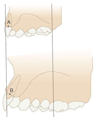 Drawings of a sagittal section through the permanent and primary incisors. The labial surface at the cervical margin is oriented in the same plane. Note that the midalveolar point of the permanent incisors (B) is more lingual than the same point of the primary incisor (A) but that the incisal edge of the permanent incisor is more labial than that of the primary incisor. 