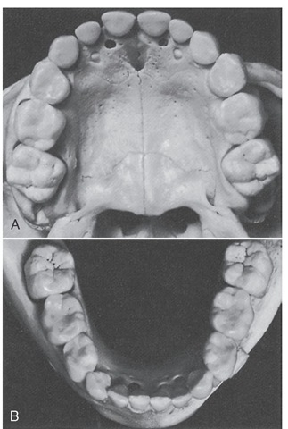 Early mixed dentition in a child with a full complement of primary teeth and first permanent molars. A, Maxilla. B, Mandible. 