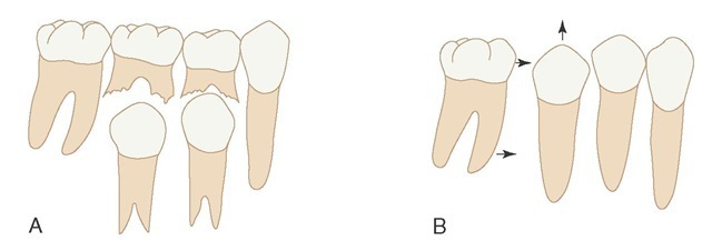 Leeway space. Difference in mesiodistal dimensions between primary teeth (A) and permanent teeth (B). Arrows indicate the mesial movement of the permanent molars after loss of primary molars and eruption of the second permanent premolar.