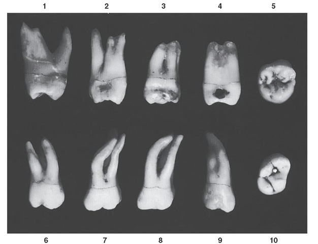 Maxillary second molar. Ten specimens with uncommon variations are shown. 1, Roots spread similar to those of first molar. 2, Bifurcated mesiobuccal root. 3, Roots very short and fused. 4, Mesiobuccal and lingual roots with complete fusion. 5, Crown similar to the typical third molar form. 6, Short roots with spread similar to that of first molar. 7, Roots extra long with abnormal curvatures. 8, Another variation similar to specimen 7. 9, Very long roots fused. 10, Crown with extreme rhomboidal form. 