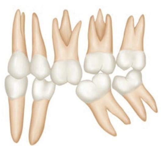 Illustration demonstrating possible migration, extrusion, and improper contacts and occlusal relations following loss of a mandibular molar. 