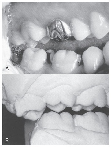  A, Hypererupted third molar due to loss of mandibular third molar. B, Casts mounted in centric relation on articulator showing undesirable centric relation contact of extruded molar with the lower molar. 