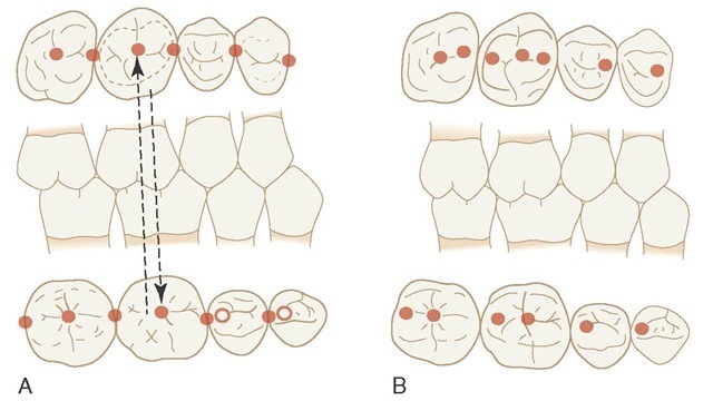 Example of idealized cusp-fossa relationship. A, Mesiolingual cusp of maxillary first molar occludes in the central fossa of the mandibular first molar. Distal buccal cusp of mandibular first molar occludes in the central fossa of the maxillary first molar. B, Concept of occlusion in which all supporting cusps occlude in fossae. 