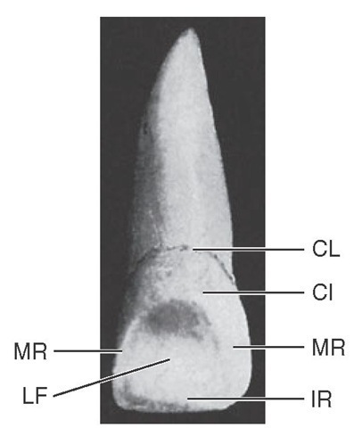 Maxillary central incisor (lingual aspect). CL, Cervical line; CI, cingulum; MR, marginal ridge; IR, incisal ridge; LF, lingual fossa. 