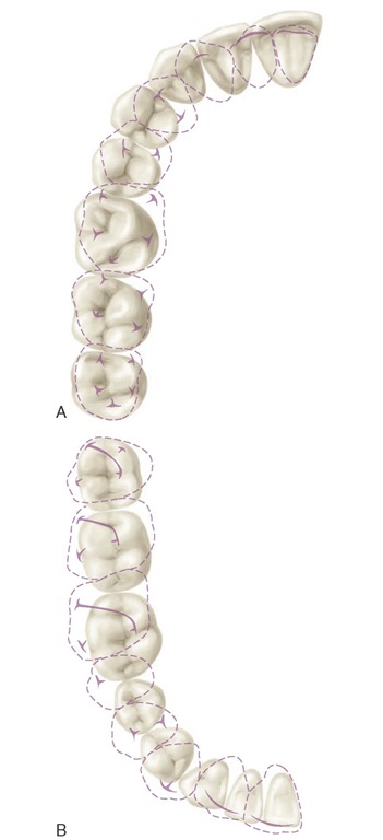 Contact relations in the intercuspal position (centric occlusion). A, Maxillary teeth with dotted lines superimposed on mandibular teeth. Heavy lines and T shapes within dotted lines denote ridges and cusp tips. B, Mandibular teeth, with dotted lines of maxillary teeth superimposed in occlusion. Note the slanted heavy lines of maxillary molars that mark the shape and location of oblique ridges. 
