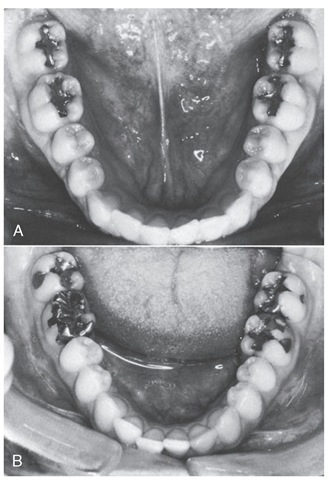 Anterior crowding. A, Absence of crowding. B, Crowding following restorative dentistry by only a few months. Clinical findings of very tight proximal contacts and an occlusal interference in centric relation are only presumptive evidence of a cause-and-effect relationship between restorative treatment and anterior crowding. 