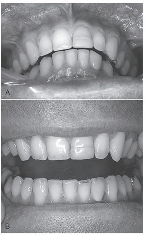 Occlusal interference to closure in intercuspal position/ centric occlusion due to restoration of the left maxillary central incisor. A, Centric relation position. B, Articulating paper mark on mandibular left lateral incisor. Temporomandibular disorder-like symptoms were relieved with adjustment of the centric occlusion interference. 