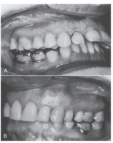 Vertical dimension. A, Use of a posterior bilateral onlay splint in an attempt to "raise the bite" and eliminate temporomandibular disorder symptoms. B, An impinging overbite may require comprehensive orthodontics for correction, not an appliance as in A. 