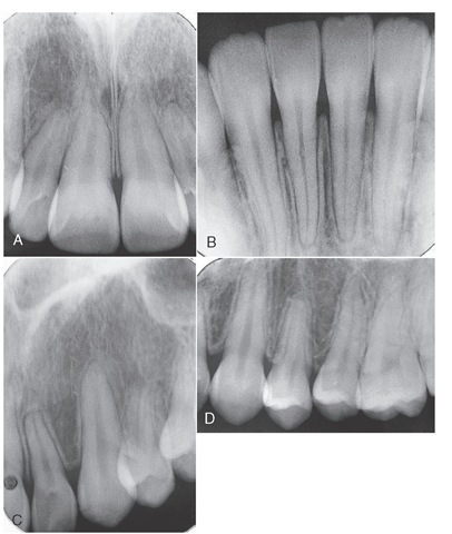 A, Large pulp chambers and pulp canals in a young adult. B, Mandibular incisors. Normal pulp canals. C, Lateral incisor and canine. Normal chambers and canals. Root resorption on lateral incisor. D, Maxillary canine and premolars with normal chambers and canals. Root resorption on first premolar associated with orthodontics. 