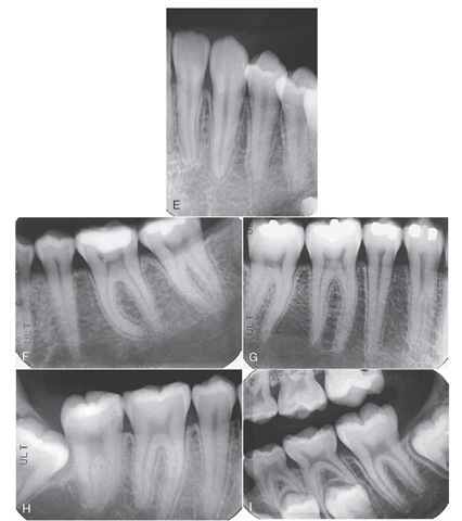  cont'd E, Mandibular lateral incisor, canine, and first premolar with normal chambers and canals. F, Mandibular second premolar and first and second molars with normal chambers and canals. Note curvature of the mesial root of the first molar. G, Mandibular molars and premolars with normal chambers and pulp canals. H, Impacted third molar adjacent to second mandibular molar. The pulp chambers and pulp canals are normal. I, First and second primary molars being resorbed in association with the erupting permanent premolars. Mandibular second molar in the process of erupting. 